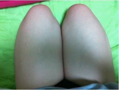 吸脂瘦腿终于让我瘦下来了，大象腿真心伤不起……