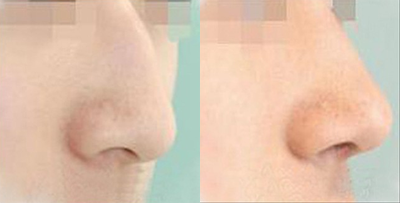 鹰钩鼻矫正手术对比案例