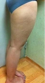 吸脂瘦腿终于让我瘦下来了，大象腿真心伤不起……