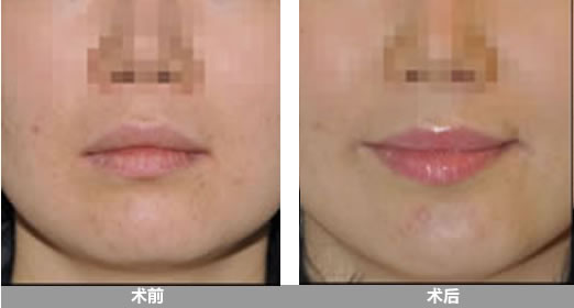 短颌矫正术对比案例