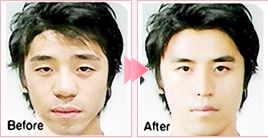 面部轮廓整形手术前后对比图