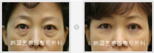 眼下脂肪再配置手术-不会复发