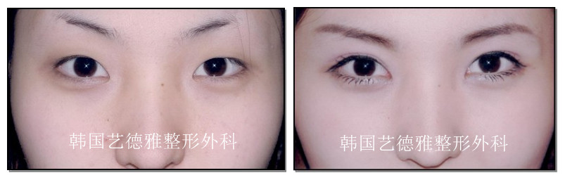 双眼皮手术前后对比照片