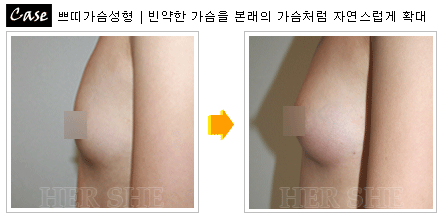 注射丰胸整形前后对比照片