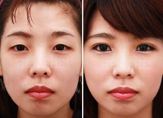 韩国赫尔希整形医院双眼皮整形前后对比照片
