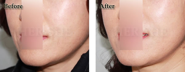 注射玻尿酸除皱案例对比图