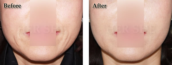 注射玻尿酸除皱案例对比图