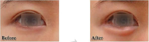 眼底娇媚术前后对比照片