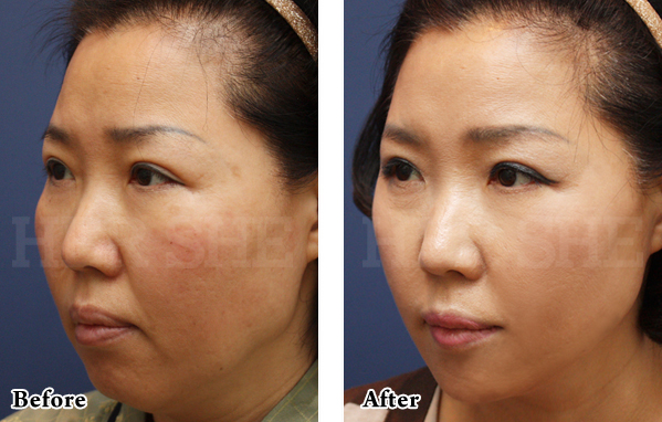 下巴整形对比案例