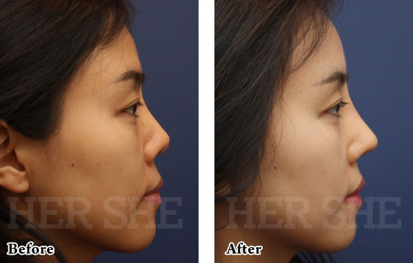 鼻部综合整形对比案例