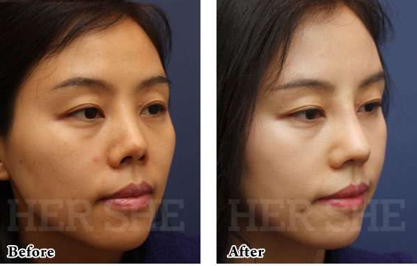 鼻部综合整形对比案例