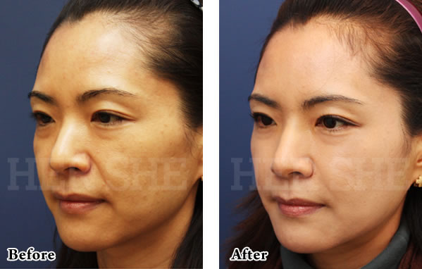 玻尿酸除皱对比案例