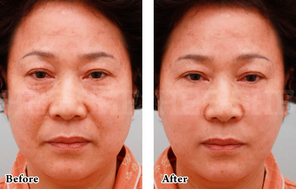 Supersell提升术+PRP施术对比案例