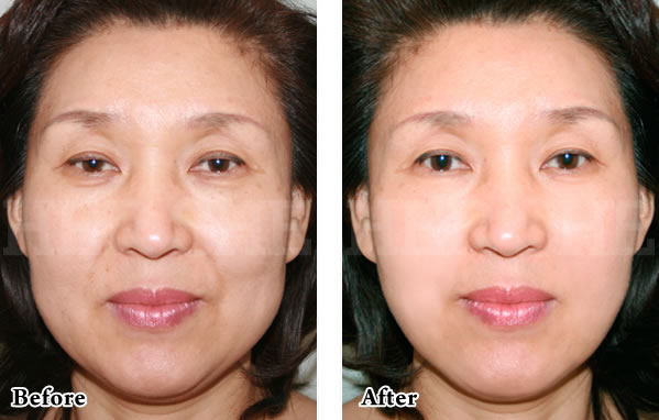 Supersell提升术+PRP施术对比案例