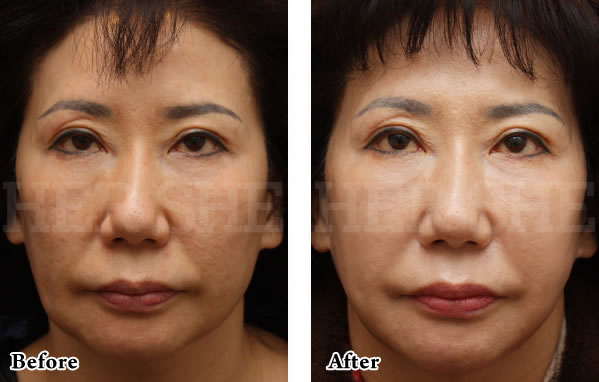 Supersell提升术+PRP施术对比案例