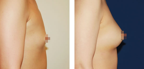 自体脂肪注射丰胸对比案例