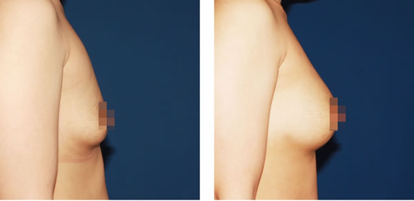 自体脂肪注射丰胸对比案例