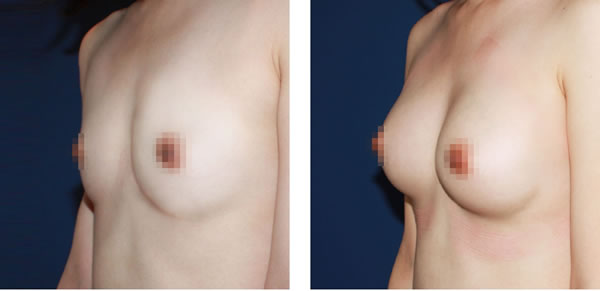 自体脂肪注射丰胸对比案例