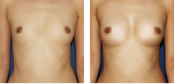 自体脂肪注射丰胸对比案例