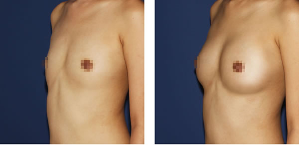 自体脂肪注射丰胸对比案例
