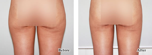 韩式3D吸脂术对比案例