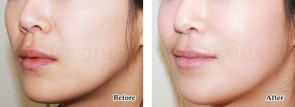 自体脂肪移植去法令纹对比案例