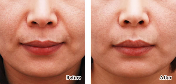 去法令纹对比案例