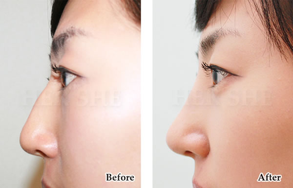 鹰钩鼻矫正术对比案例