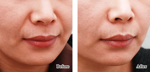 去法令纹对比案例