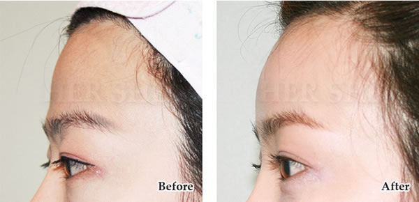 额头脂肪移植对比案例