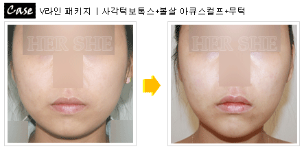 V-pack脸部线条整形前后对比照片