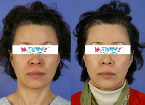 拉皮手术对比案例