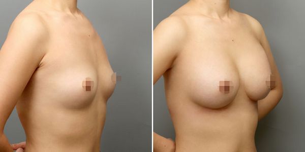 假体隆胸手术案例对比图