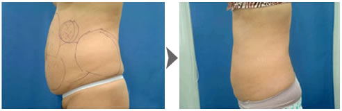 高频热分解溶脂术