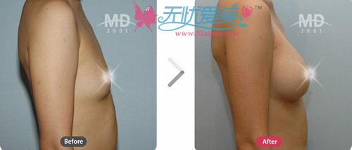 韩国MD整形医院隆胸对比案例3 韩国MD整形医院隆胸对比案例3