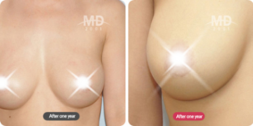 假体隆胸整形术前后对比照片