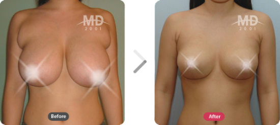 胸部整形手术前后案例对比照片