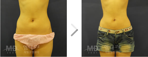腰腹吸脂整形术前后对比照片