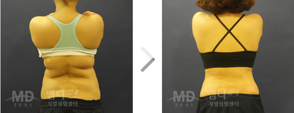 背部吸脂整形手术前后对比照片