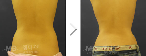 腰部吸脂整形手术前后对比照片