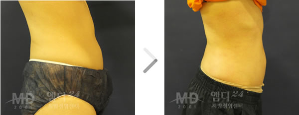 腰腹吸脂整形前后对比照片