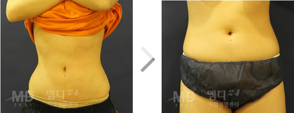腰部吸脂手术前后对比照片
