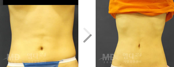 腰部吸脂手术前后对比照片