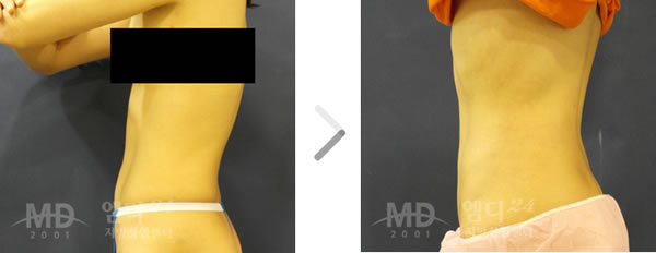 腰部吸脂整形术前后对比照片