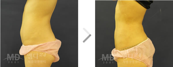 腹部吸脂手术前后对比照片