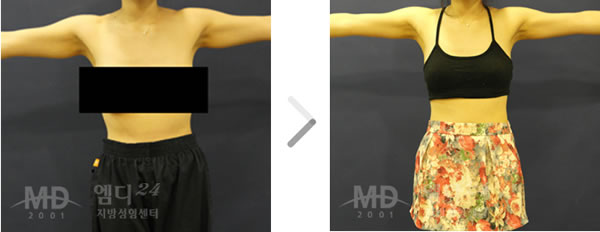 手臂吸脂手术前后对比照片