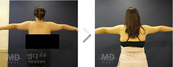 手臂吸脂整形前后对比照片