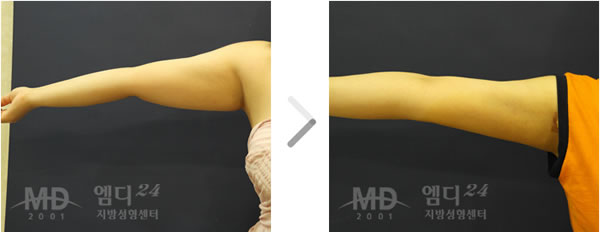 手臂吸脂手术前后对比照片