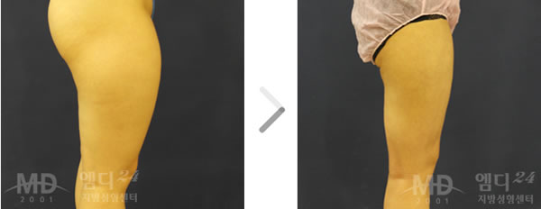 大腿吸脂手术前后对比照片