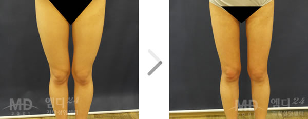 腿部吸脂手术前后对比照片